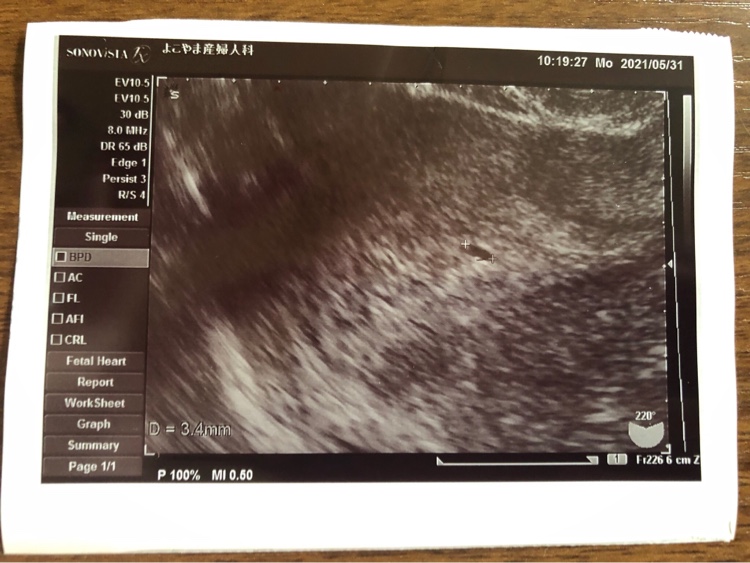胎嚢が小さい 体外受精で妊娠判定をいただき 前回の病院で胎嚢確認ができま