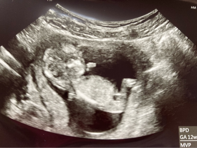 性別について ただ今妊娠12w4dです 今日検診でエコーを確認しました